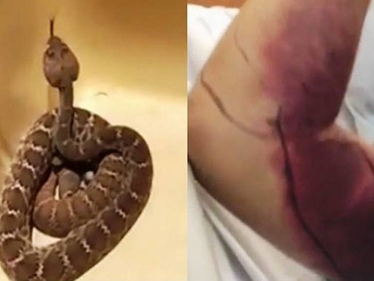 सापासोबतचा सेल्फी भलताच महागात, उपचारासाठी 96 लाखांचा खर्च!