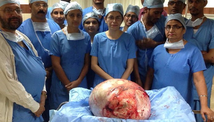  महिलेच्या पोटातून ३५ किलोची गाठ 