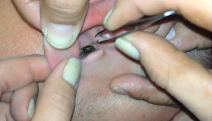 तरूणाच्या कानाता तब्बल २६ झुरळ 