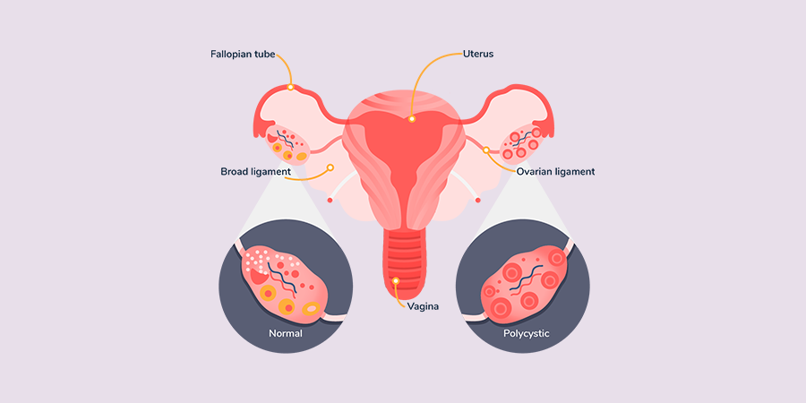 World PCOS Awareness Month – It’s Information and prevention