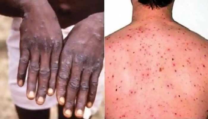 Monkeypox case reported in US after 18 years