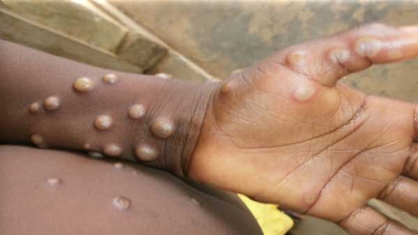 Karnataka: Guidelines issued by Government to prevent the spread of Monkeypox